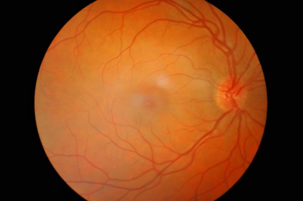 Retina Test, Fundus Checkup, Dilated test, Diabetes in retina